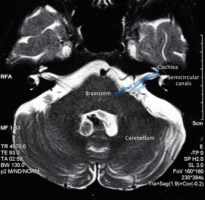 Vestibular schwannomas